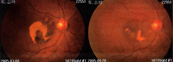 Melatonin Zn Se effect on cataract - Figure 1
