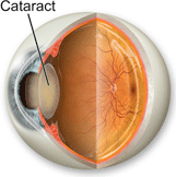 cataract anatomy
