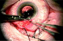 cataract surgery shot