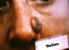 BCC nose leison before Curaderm treatment
