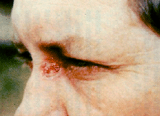 SCC during Curaderm treatment