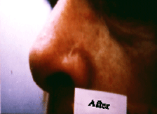 BCC nose leison after the treatment of Curaderm